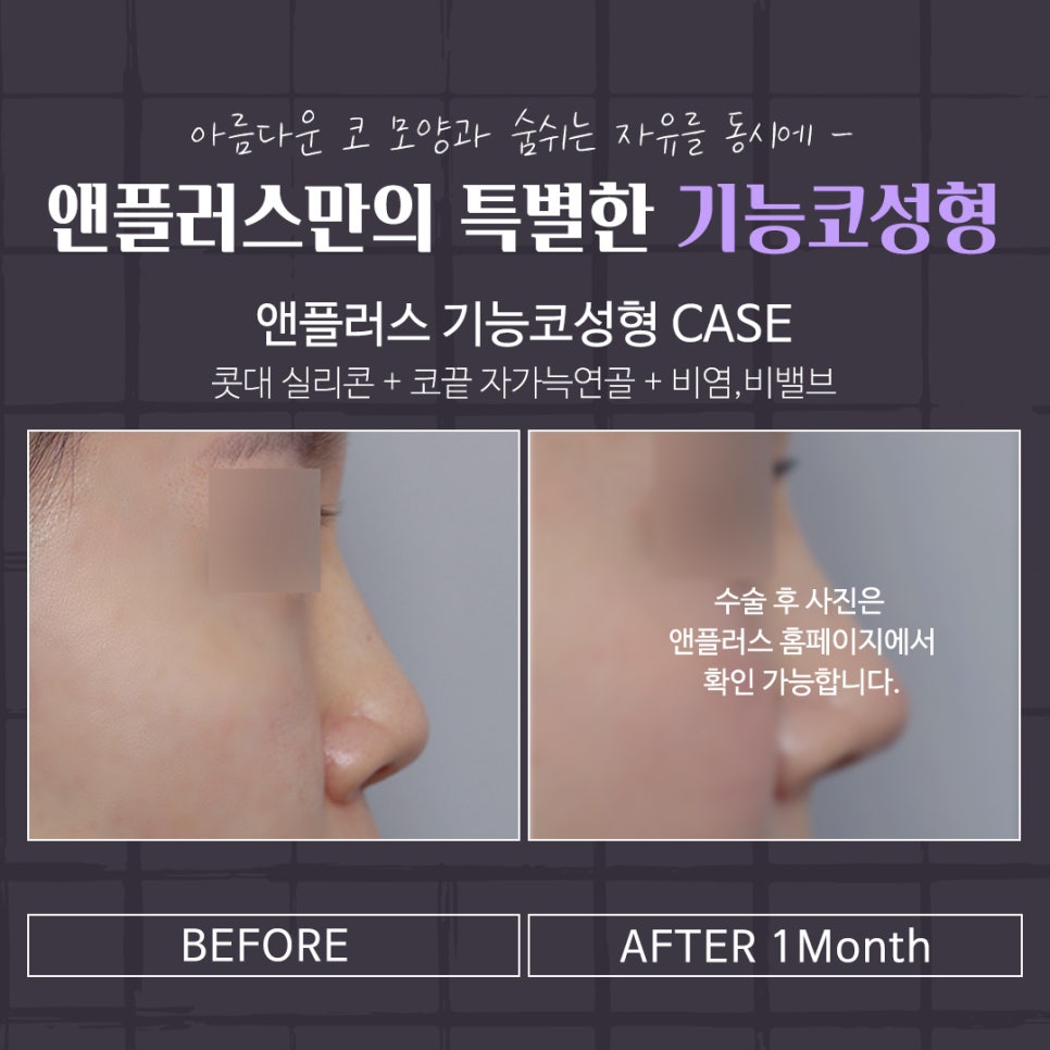 코성형후기 만족스러운 결과 관련 이미지 12