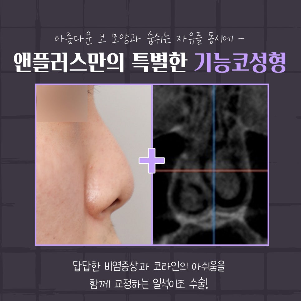 코성형후기 만족스러운 결과 관련 이미지 5