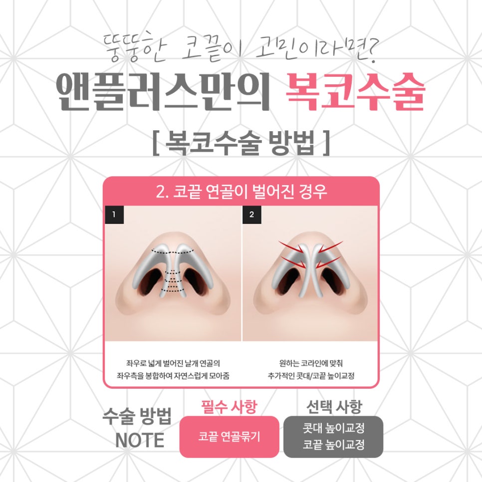 복코수술후기 뚱뚱한 코끝 개선 관련 이미지 6