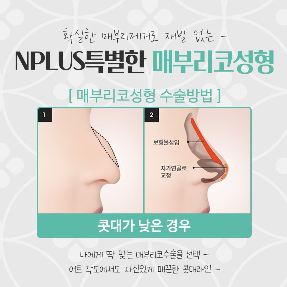 매부리코성형후기 부드러운 인상으로 관련 이미지 11