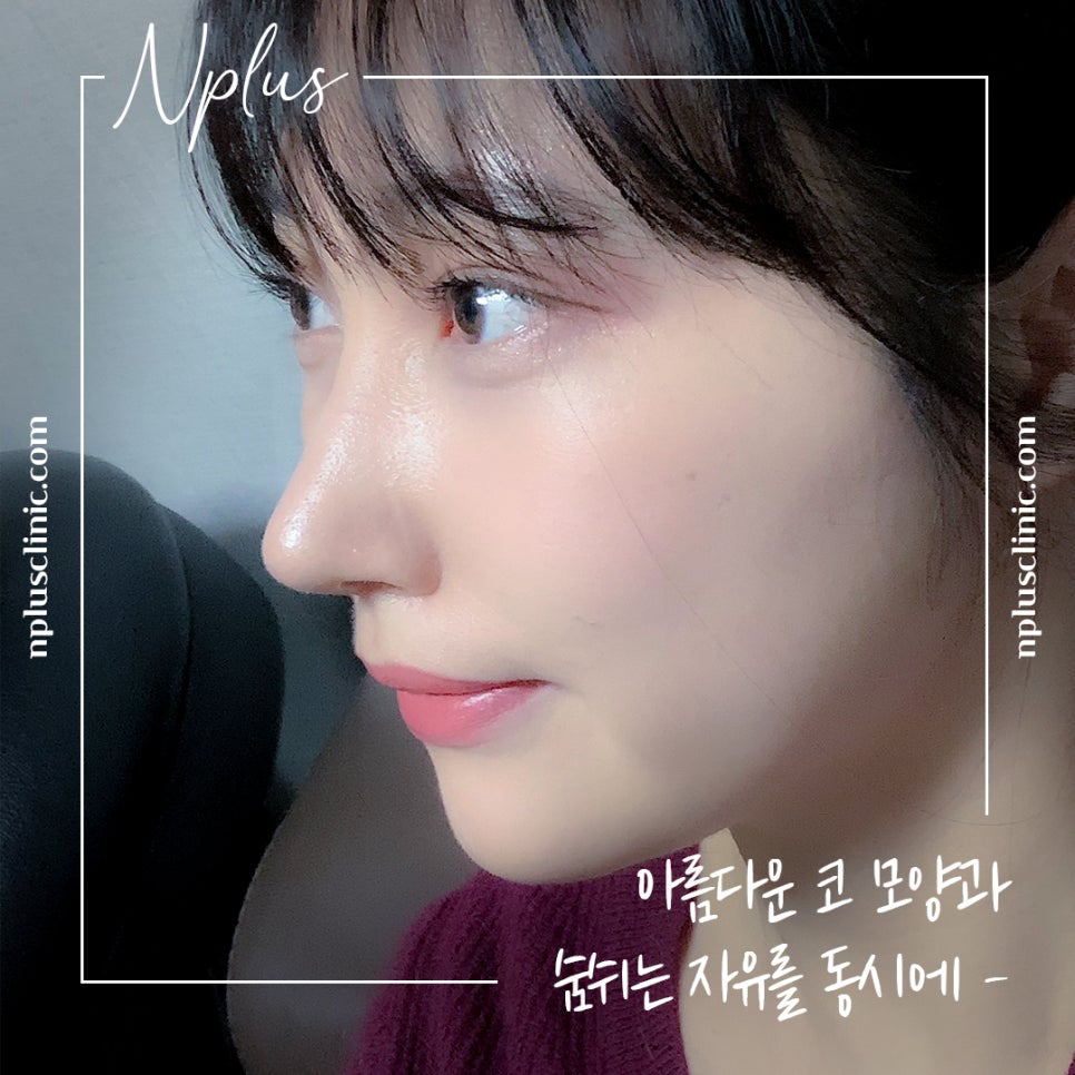 A Satisfying Result with One Rhinoplasty and Rhinitis Surgery image 2