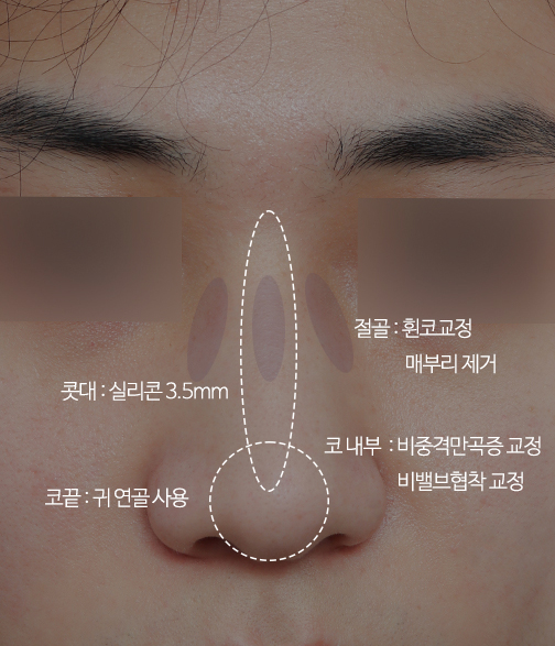 남자매부리코_비염수술과 동시에 관련 이미지 7