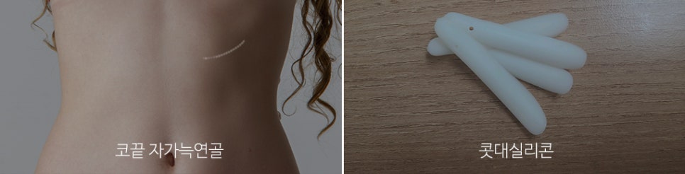 복코수술후기_뭉툭한 코라인을 자연스럽게 관련 이미지 4