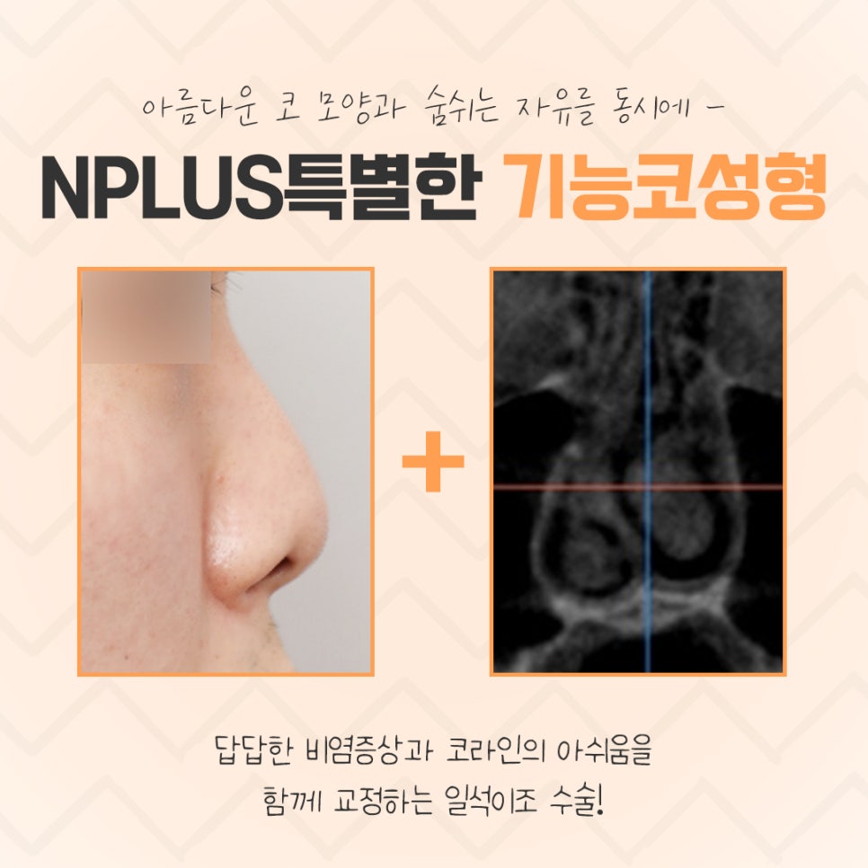 기능코수술후기 자세하게 알아봐야 관련 이미지 3