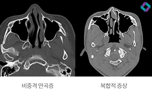 기능코성형 비중격만곡증(비중격교정술)과 코막힘원인 관련 이미지 5