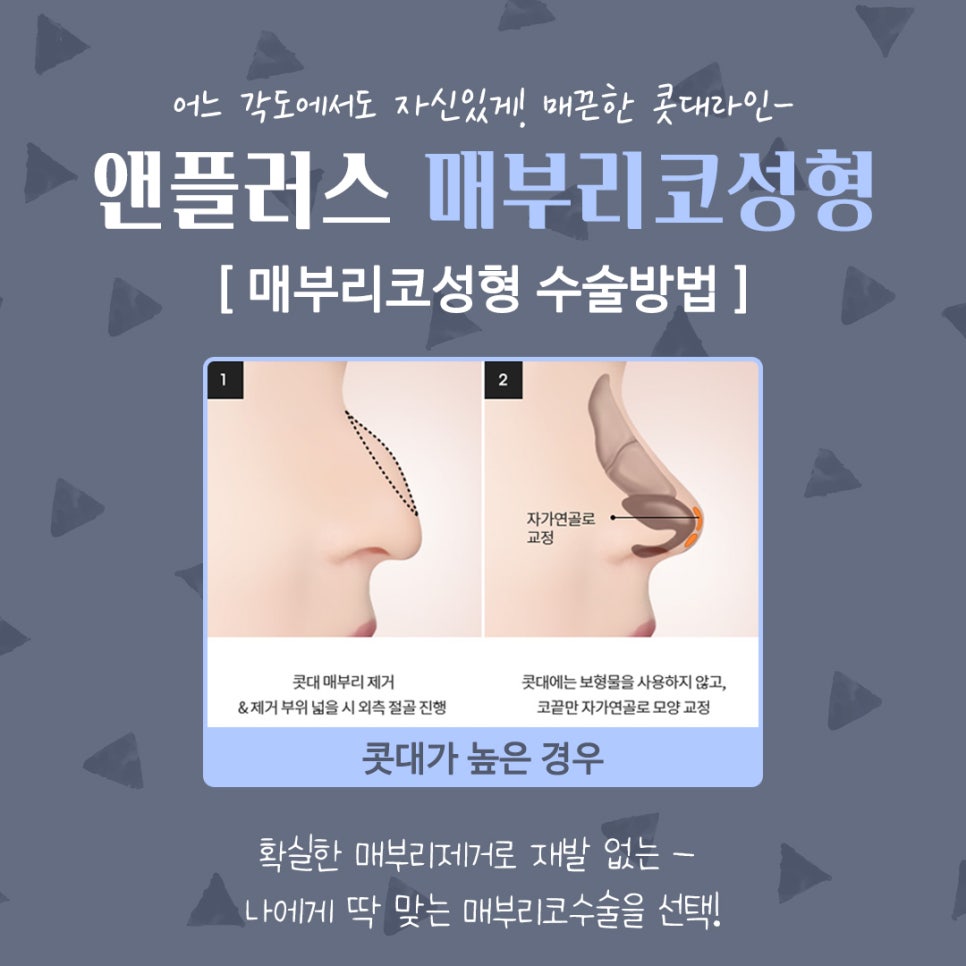 남자매부리코성형 기능까지 고려해서 관련 이미지 7