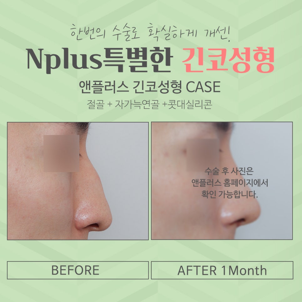 Long Nose Surgery: From Looking Older to Looking Younger image 5
