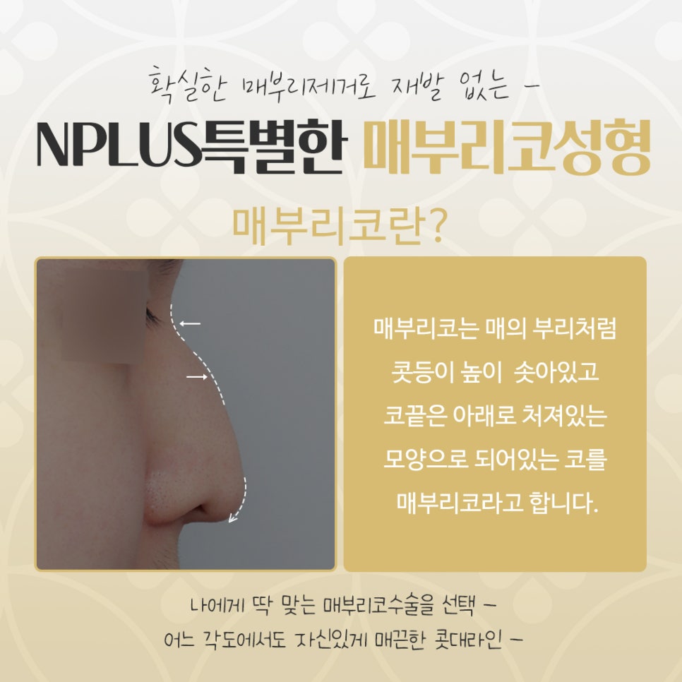 매부리코수술후기 확실하게 확인하여 관련 이미지 3