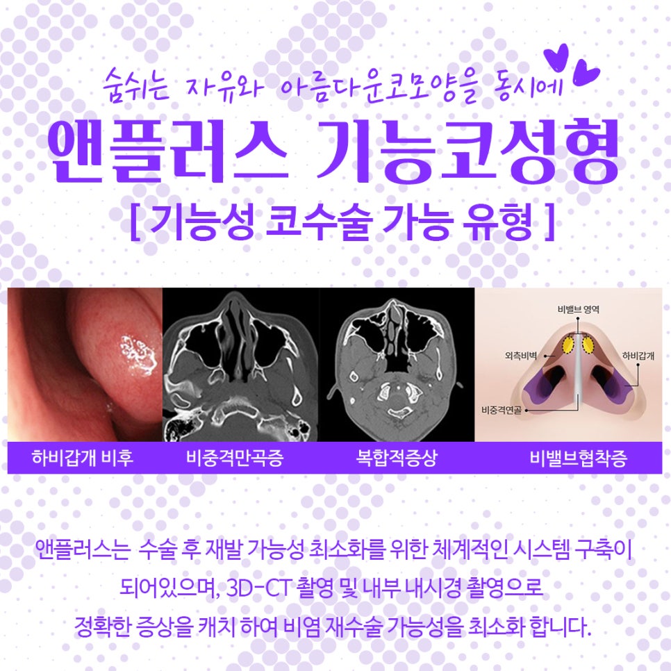 Nose Surgery Review from Anplus Plastic Surgery image 5