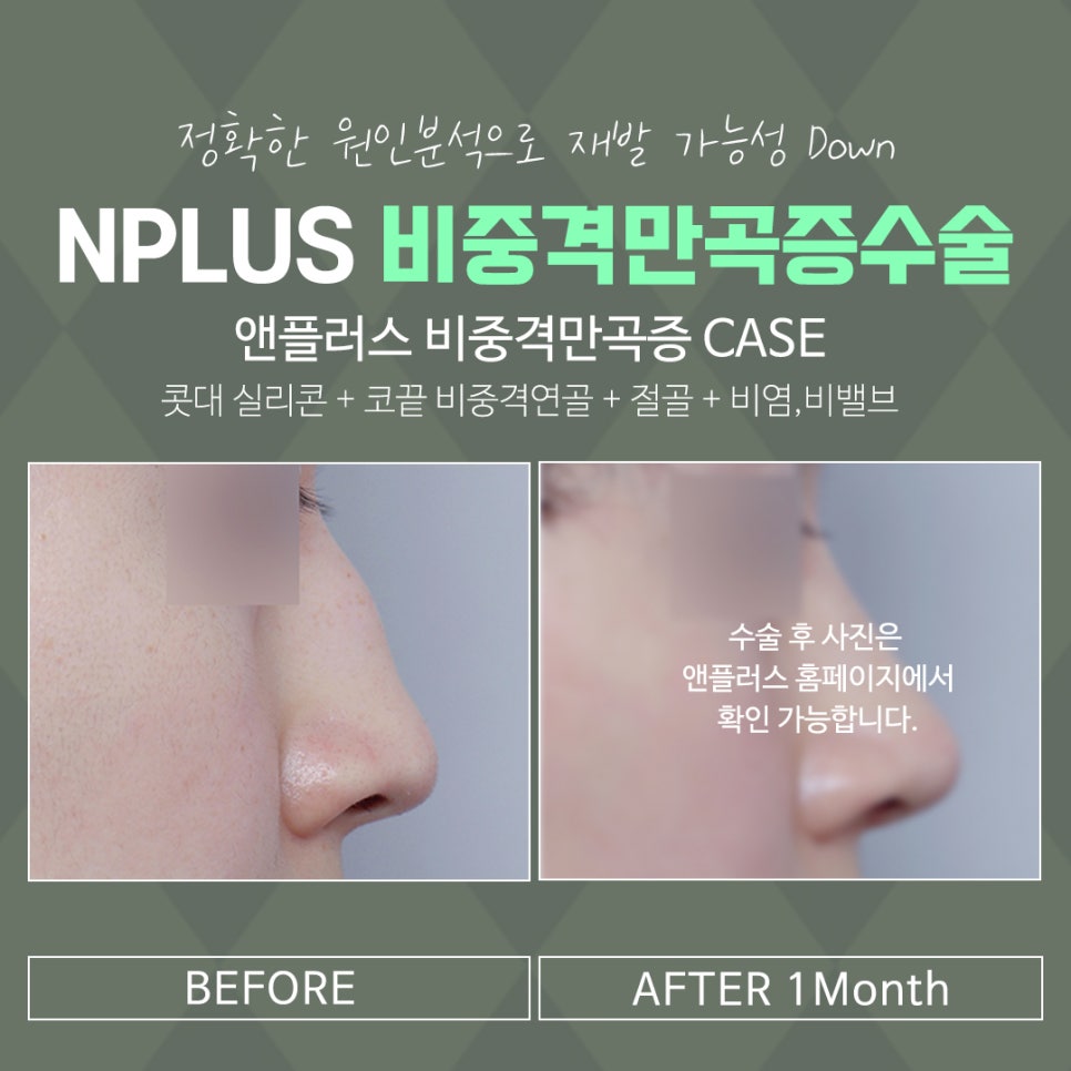 비중격코수술 원인 파악을 확실하게 관련 이미지 13