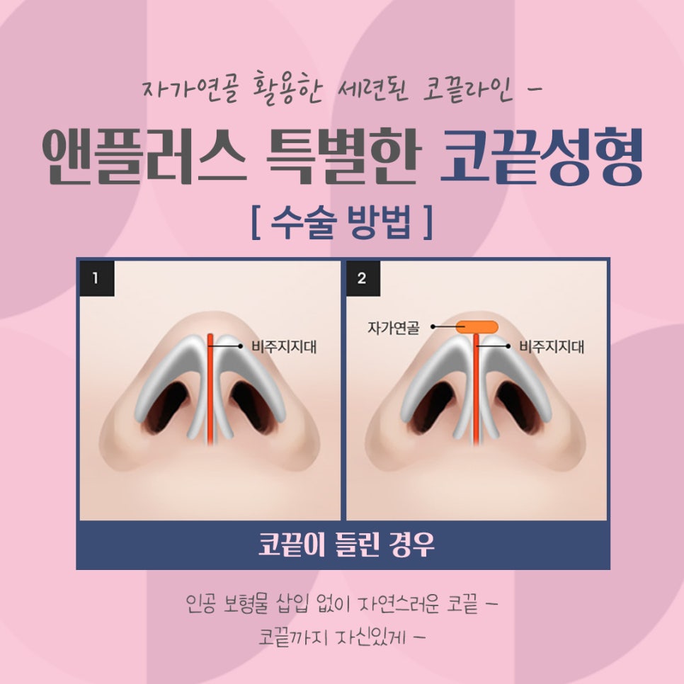 코끝처짐 개선한 코끝성형후기 관련 이미지 8