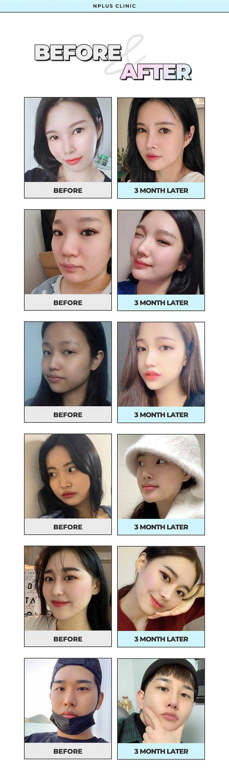 2023 수험생 할인 앤플러스에서 진행한 코수술이벤트🤞 관련 이미지 5