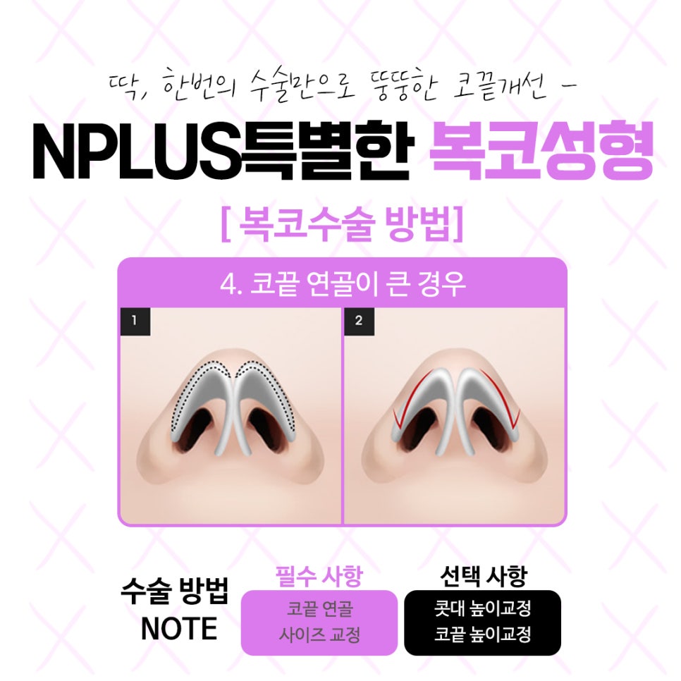 복코수술후기 자연스럽고 예쁜 라인으로 관련 이미지 10