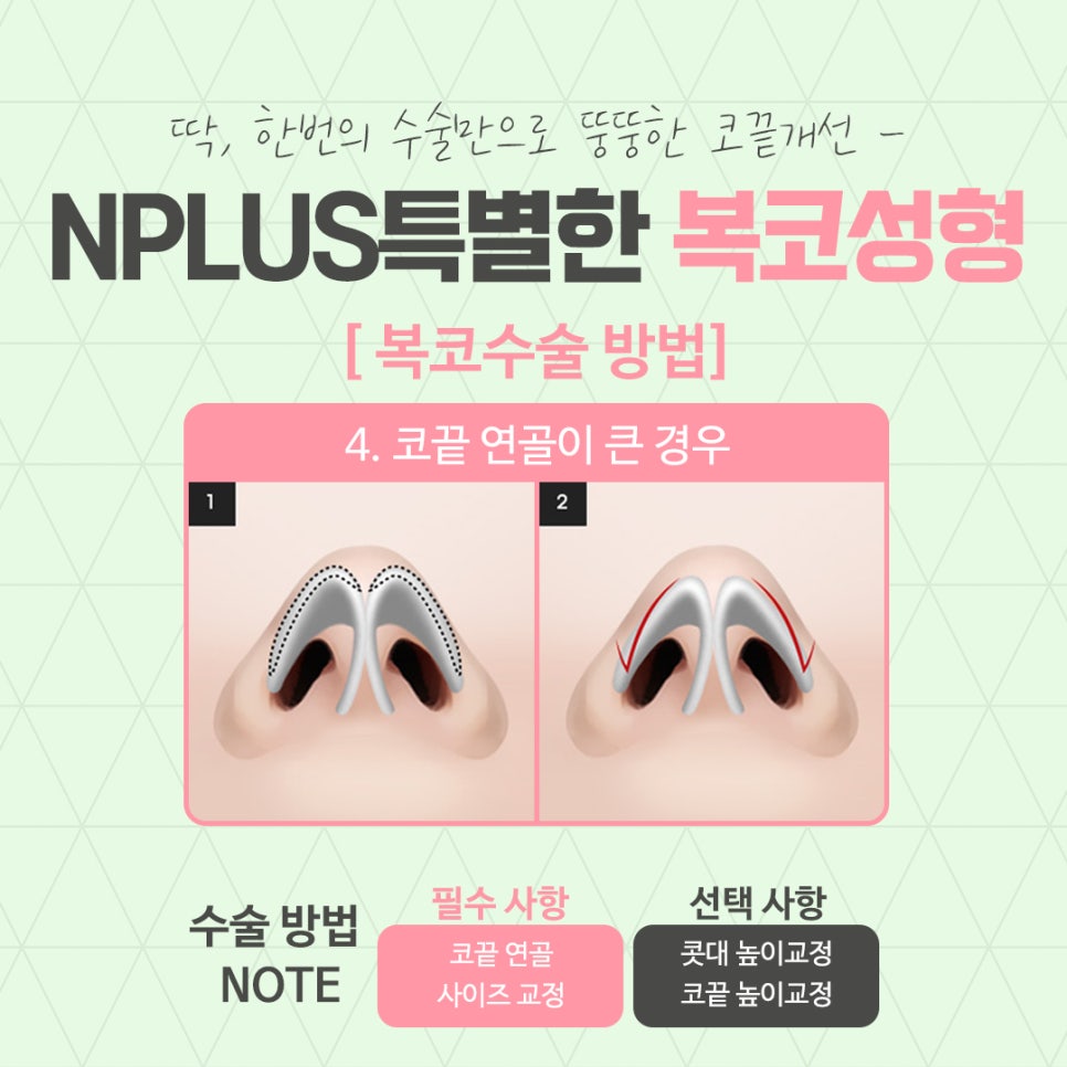 Before and After Bulbous Nose Surgery: Accurately Identifying the Cause image 10
