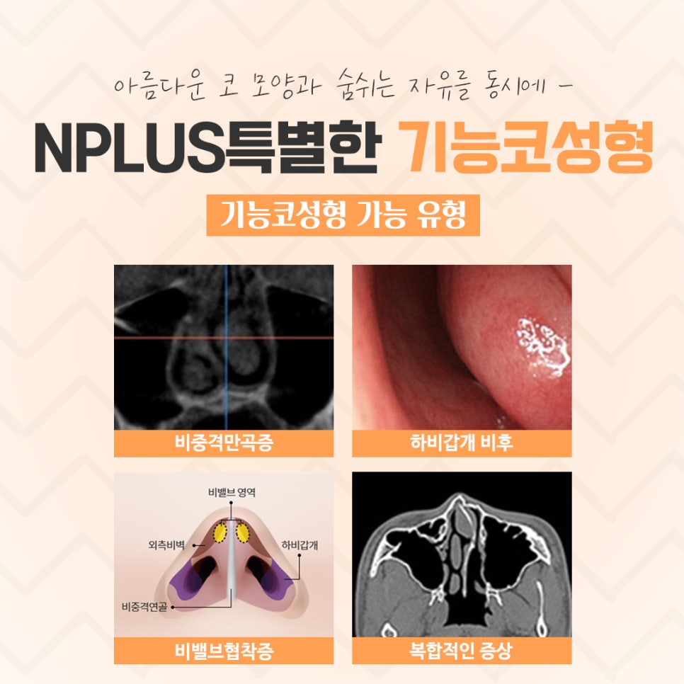 기능코수술후기 자세하게 알아봐야 관련 이미지 5