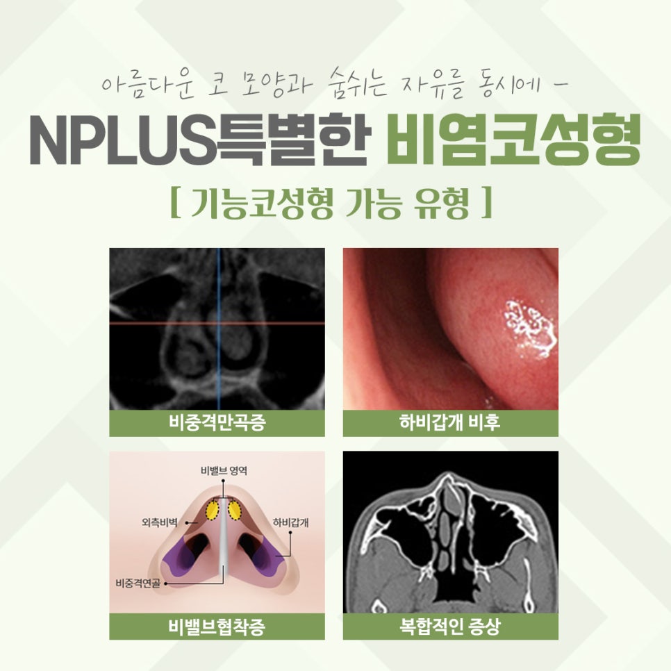 비염코수술후기에 대해 확인하여 관련 이미지 4