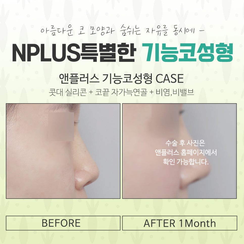 기능코수술후기에 대한 내용을 비교하여 관련 이미지 14
