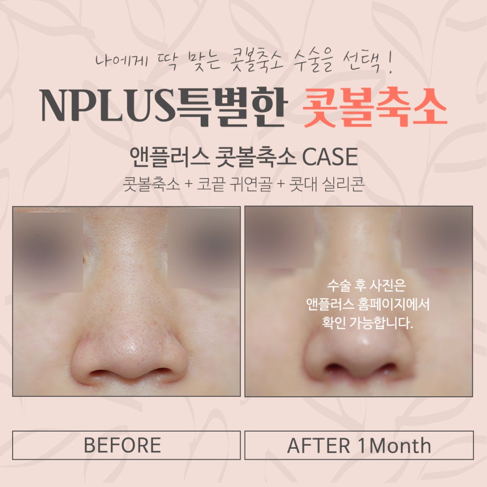 A Review of Nostril Reduction Surgery for a More Refined Look image 6
