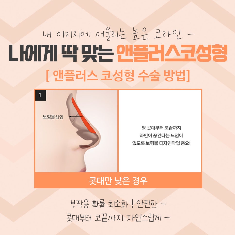 코성형 후기로 알아보고 결정 관련 이미지 10