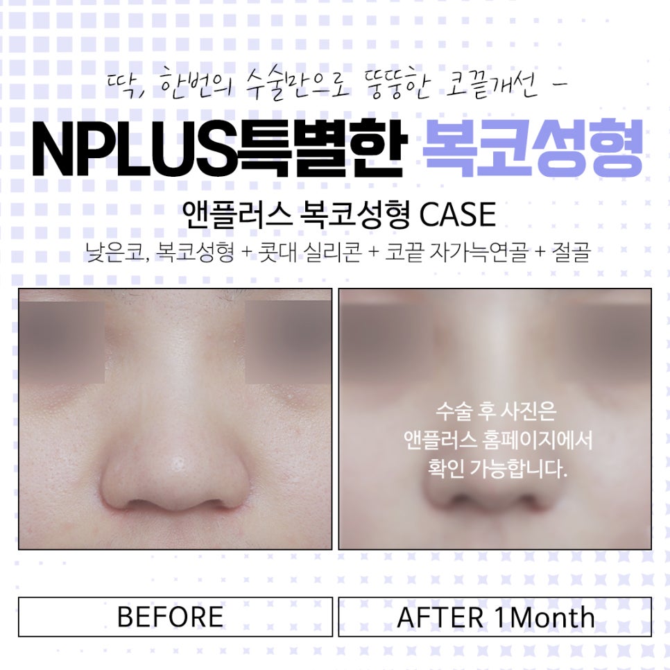 복코수술전후에 대해 자세히 찾아보고 관련 이미지 15