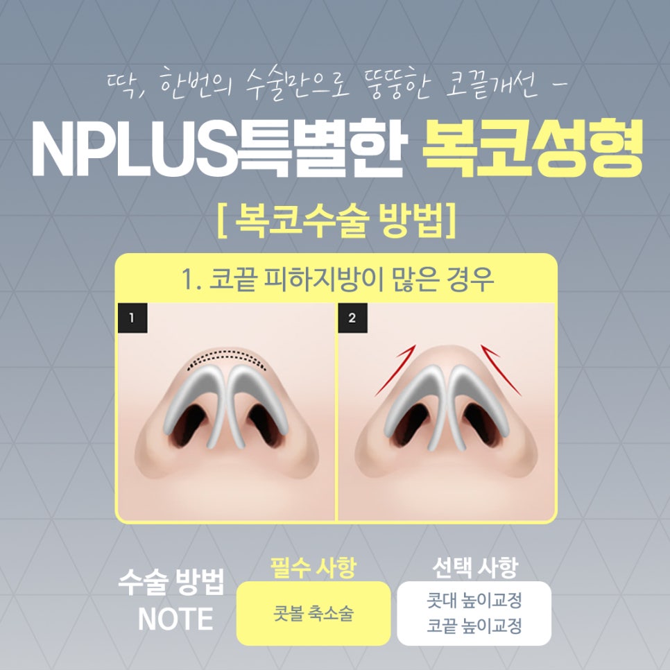 복코수술후기 조화로운 얼굴 라인 관련 이미지 6
