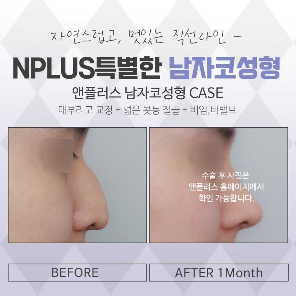 Looking Closely at Before-and-After Male Nose Surgery image 14