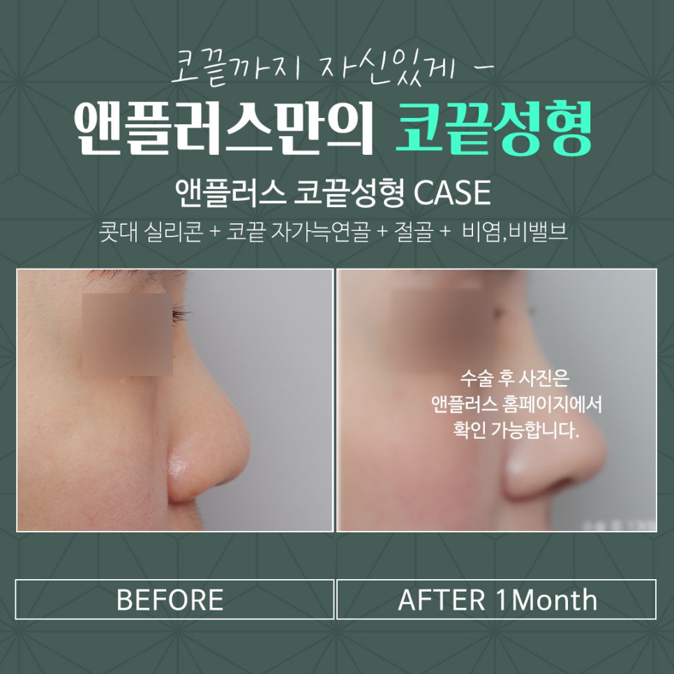 코끝연골묶기 활용한 코끝성형 관련 이미지 5