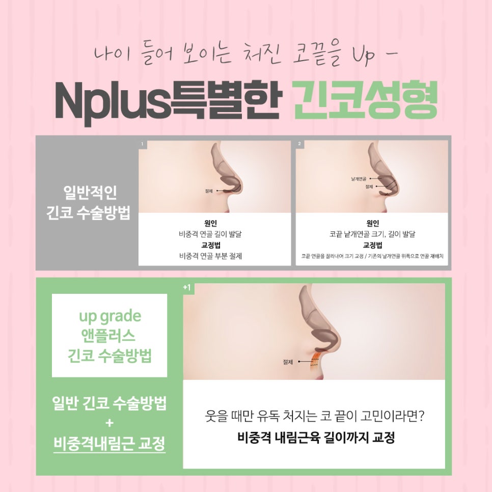 긴코성형으로 교정하고 동안 되자 관련 이미지 7