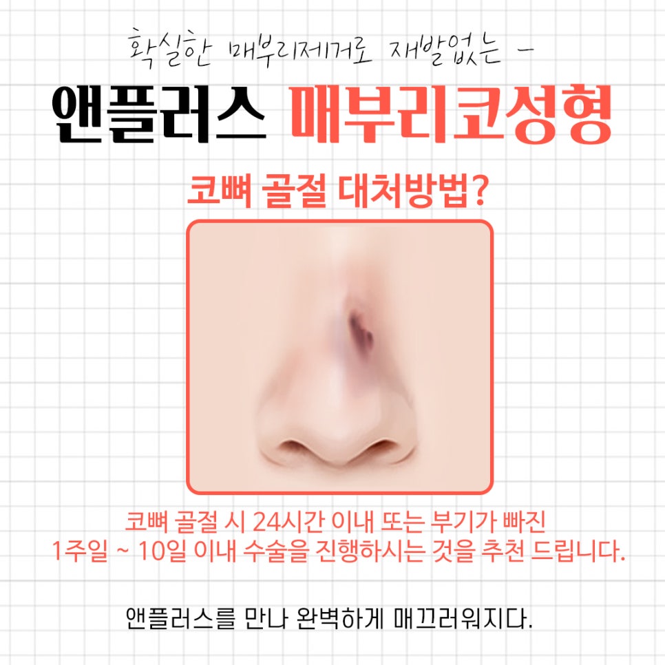 A Complete Guide to the Causes of a Hump Nose and Surgical Methods image 6