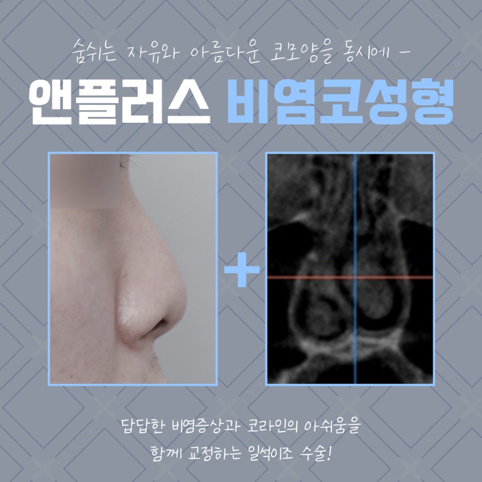 Nasal Correction Rhinoplasty Review: Identifying the Cause Properly image 3