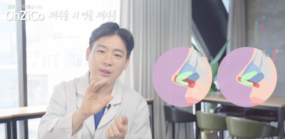 Let Us Explain Whether Cartilage Can Be Reused in Revision Rhinoplasty! image 10