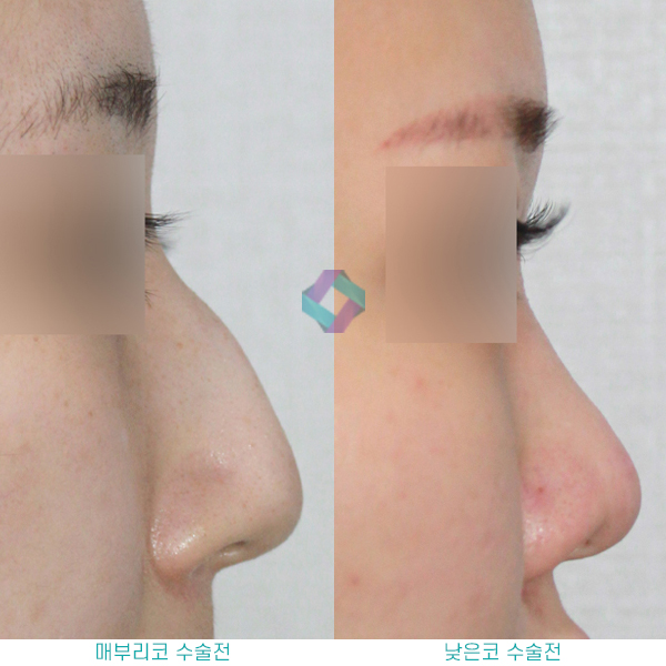 낮은코성형후기 참고하고 상담할때 관련 이미지 4