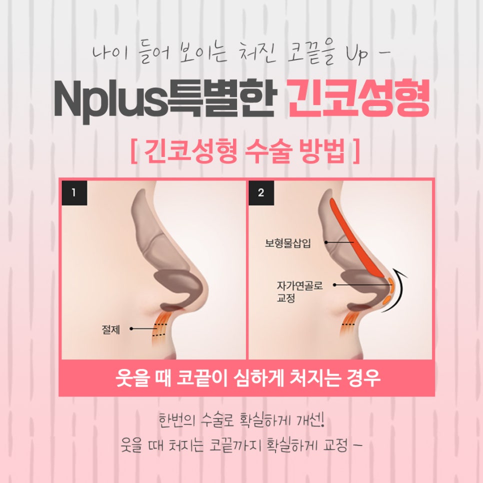 긴코성형 자연스럽게 교정하여 관련 이미지 9