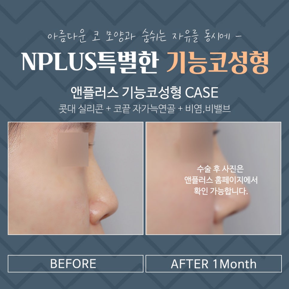기능코성형후기 정확한 원인 분석으로 관련 이미지 16