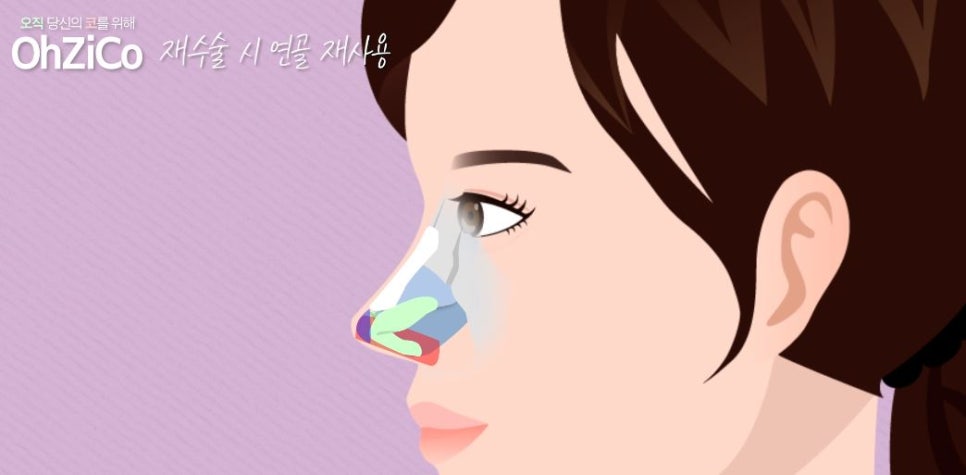Let Us Explain Whether Cartilage Can Be Reused in Revision Rhinoplasty! image 3