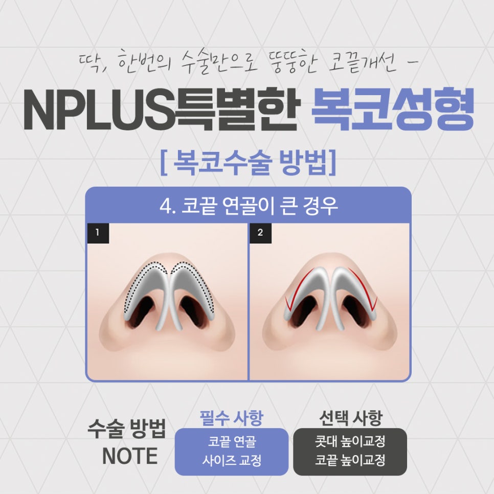복코성형후기로 알아보는 코지방제거 관련 이미지 9