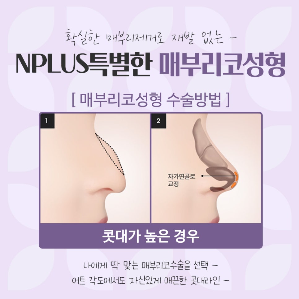 Check the Hump Nose Surgery Review in Detail image 8