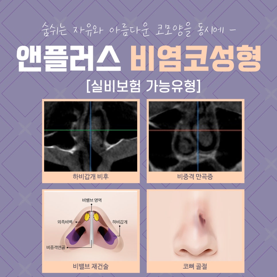 Looking Into Rhinitis Rhinoplasty Reviews and Benefits image 15