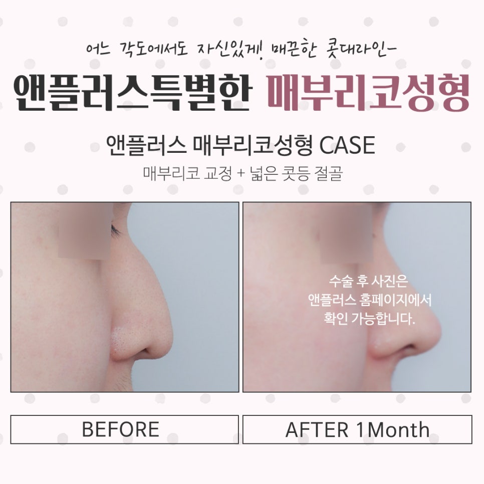 매부리코성형후기 꼼꼼하게 알아보고 관련 이미지 15