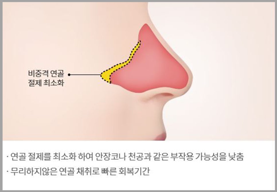 비염코성형? 어렵지 않아요. 관련 이미지 11