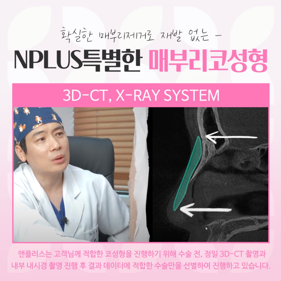 매부리코수술전후 비교를 한다면 관련 이미지 6