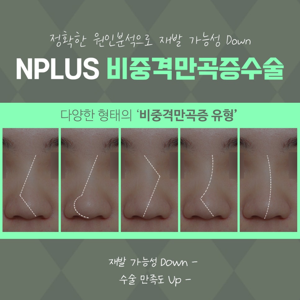 비중격코수술 원인 파악을 확실하게 관련 이미지 7