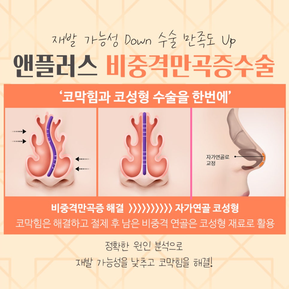비중격만곡증수술후기 코 내부를 정확하게 파악해야 관련 이미지 10