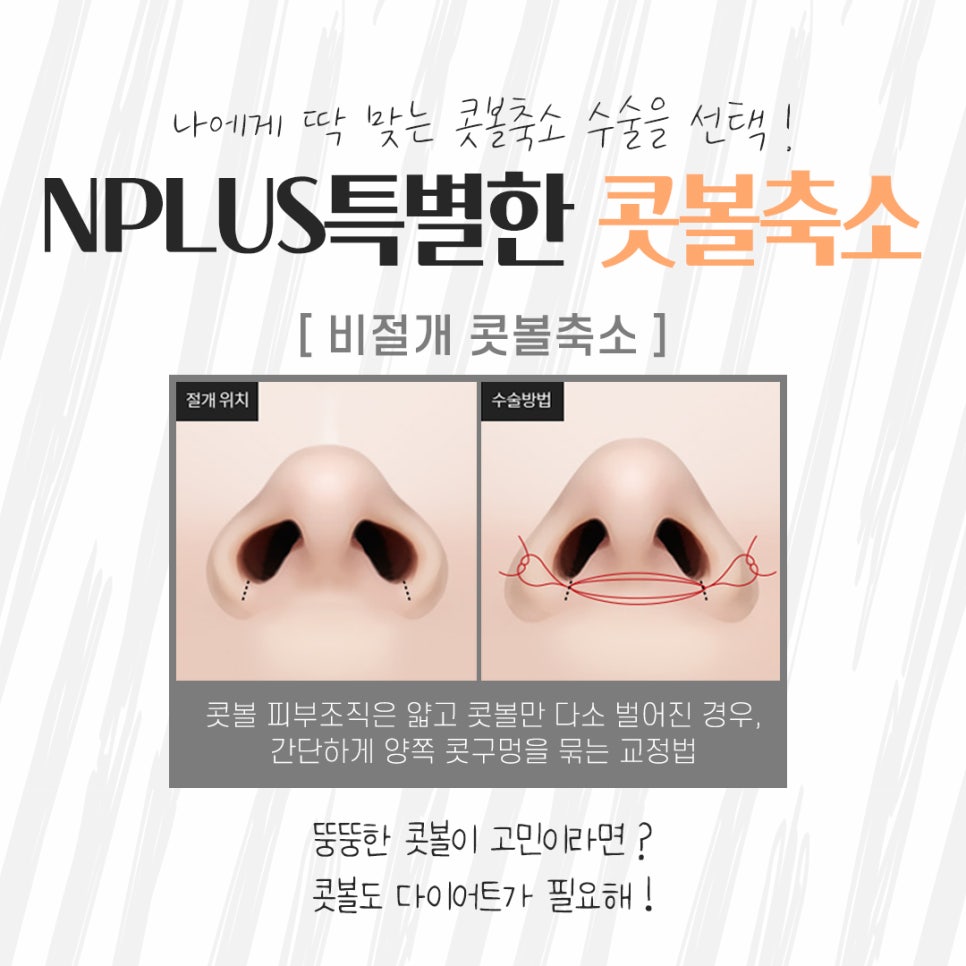 Looking into Nasal Ala Reduction Surgery Methods image 9