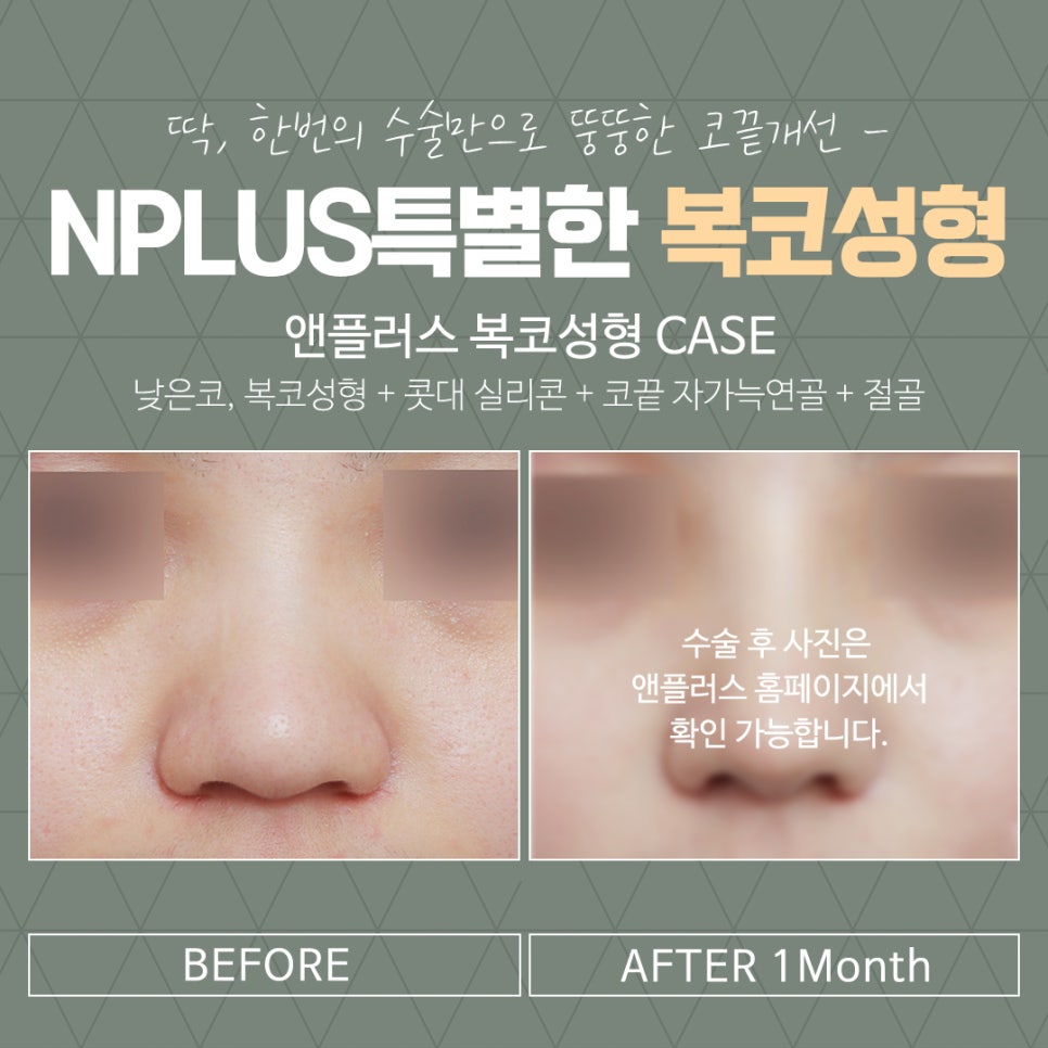 복코성형으로 세련된 이미지 변신 관련 이미지 4