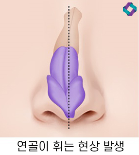 늑연골 코성형 : 자가연골의 장점과 단점 (자가연골 비교) 관련 이미지 9