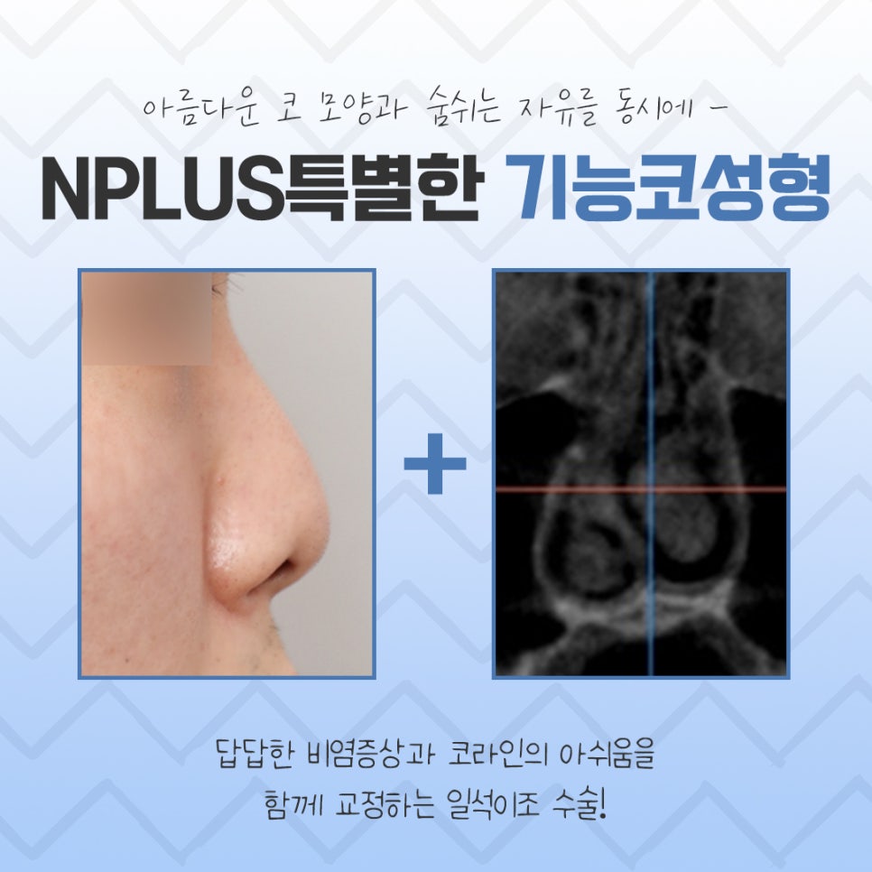 비염수술전후 확실한 차이를 알아보고 관련 이미지 3
