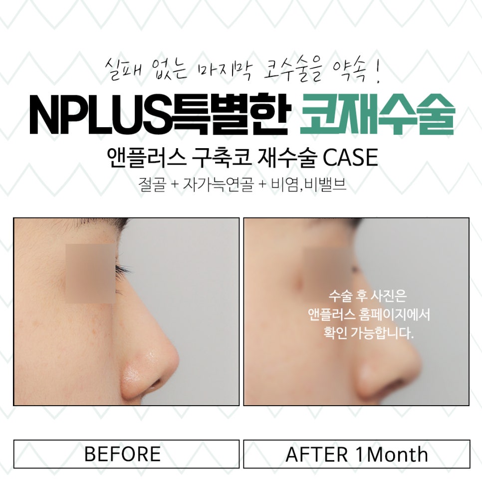 코재수술성형외과 신중하게 알아보고 관련 이미지 15