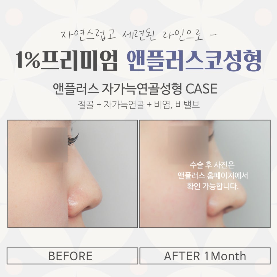 자가늑연골코성형으로 자연스럽지만 화려한 코 라인! 관련 이미지 15