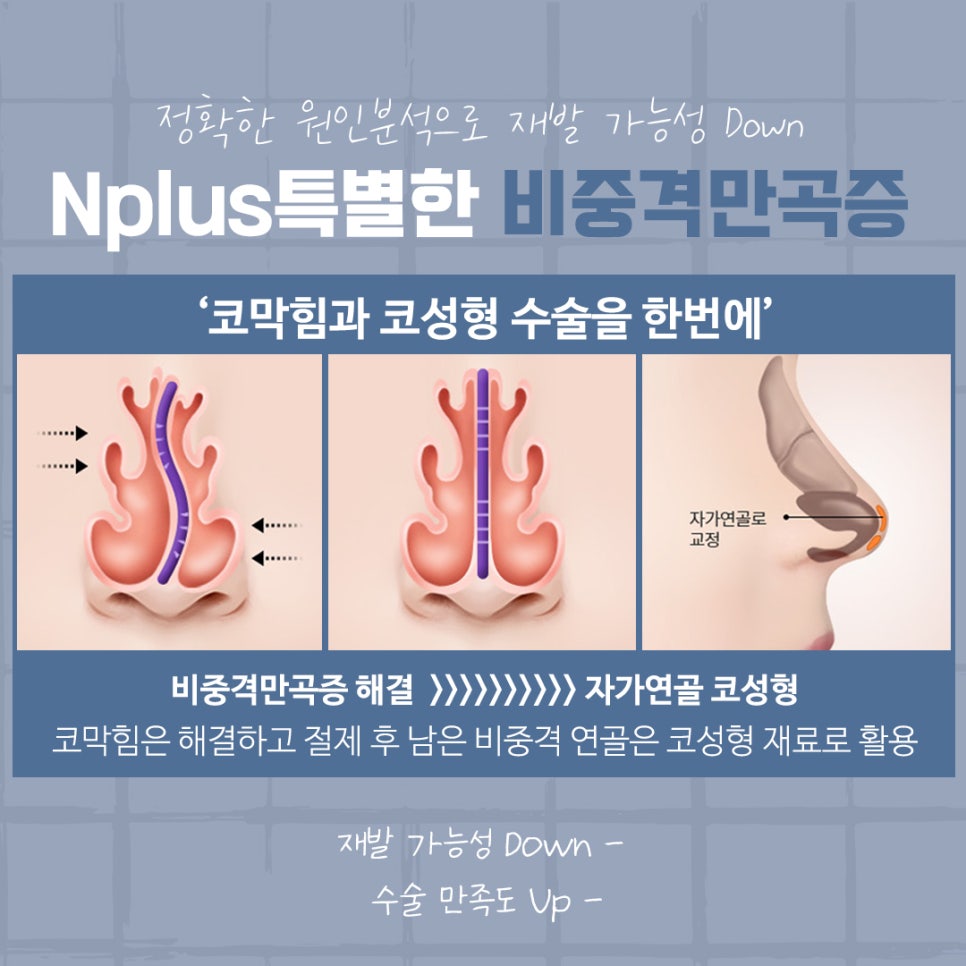The Importance of Choosing a Septoplasty Review image 10